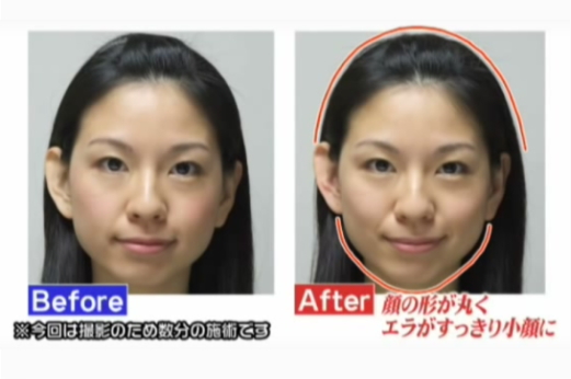 小顔矯正 ビフォーアフター